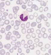 BAND OR JUVENILE NEUTROPHILS Of neutrophil lineage with non-segmented