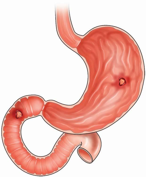 What Is Peptic Ulcer Disease? Peptic ulcer disease is when painful sores form in the lining of the stomach, duodenum (start of the small intestine) or bowels.