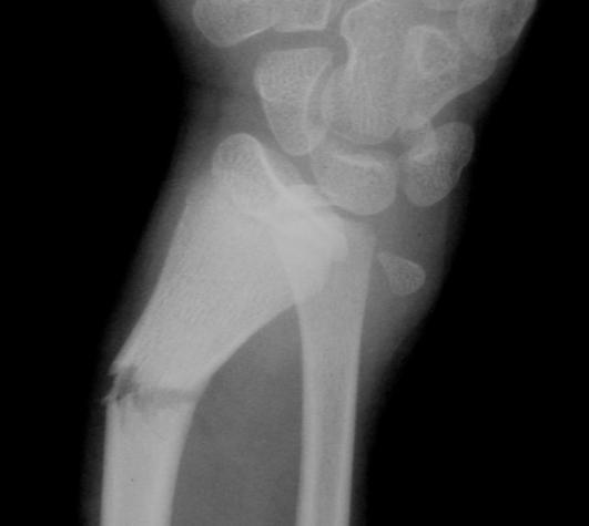 , and McLaren, CANA: Galeazzi Fractures in Children. J. Bone Joint Surg., 69B:730-733, 1987.) Type-A Type-B Fig. 19. Radiographs of Galleazzi Fractures 2.