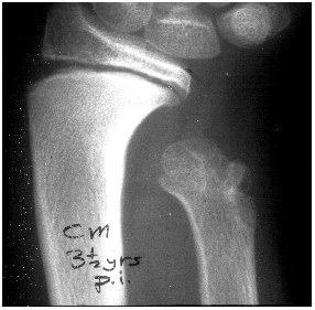 Ill. 3. Beware the Type B Fractures. They are unstable! a. A reverse 3-point molding of the cast at the fracture site is required if the fracture is stable with closed reduction alone. b.