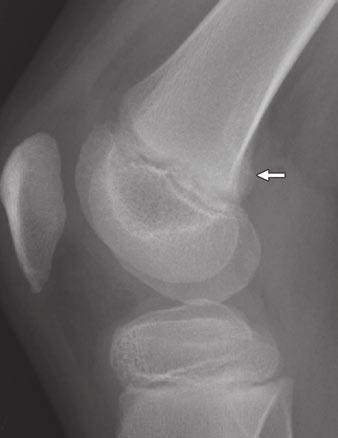 Other associated signs of trauma were found in eight patients, including injury to the extensor mechanism (four patients), anterior cruciate ligament sprain (two patients), medial meniscal