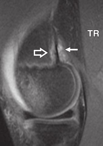 MRI can provide additional information regarding associated soft-tissue and osseous abnormalities, as found in our series.