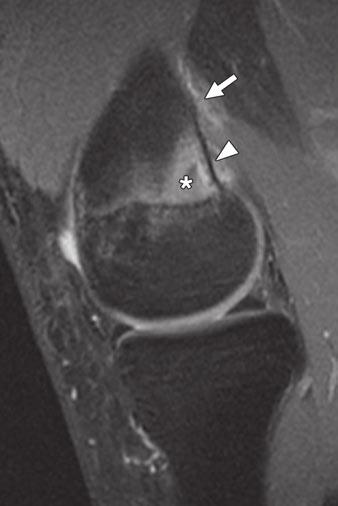 associated with bone marrow edema and periostitis. Intratendinous and peritendinous T2 hyperintensity at origin of medial head of gastrocnemius tendon (solid arrow) also is present.