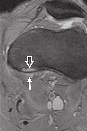 Sagittal fat-suppressed proton density weighted () and axial T2*-weighted gradient-echo () MR images show hyperintense well-marginated juxtacortical lesion (open arrow, ) associated with metaphysial