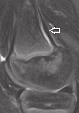 Oblique coronal proton density weighted fatsuppressed image shows cortically based, welldefined lesion (arrow) along medial margin of distal femoral diaphysis with no associated bone marrow edema.