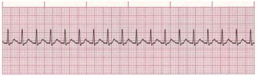 Atrial Tachycardia Rate Regularity P waves PR interval QRS duration