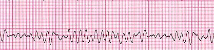 Ventricular Fibrillation Rhythm: irregular (coarse or fine), wave form varies in size and