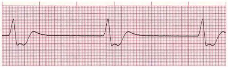Idioventricular Rhythm Escape rhythm (safety mechanism) to prevent ventricular standstill HIS/Purkinje system takes