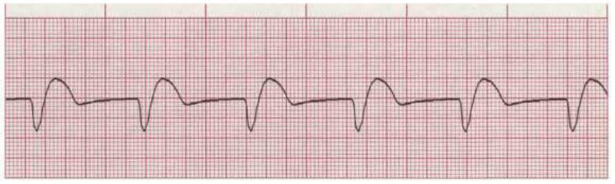 Accelerated Idioventricular Rhythm Escape rhythm (safety mechanism) to prevent ventricular standstill Bundle of HIS/Purkinje Fiber