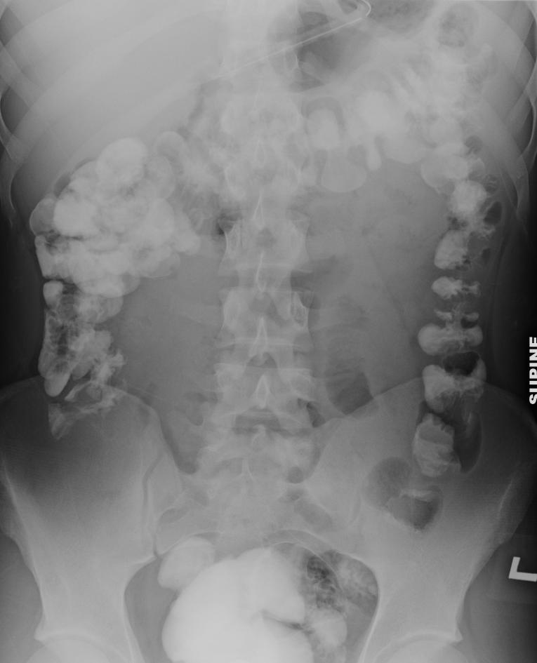 Abdominal X-ray s/p gastrograffin enema, with residual contrast lining the