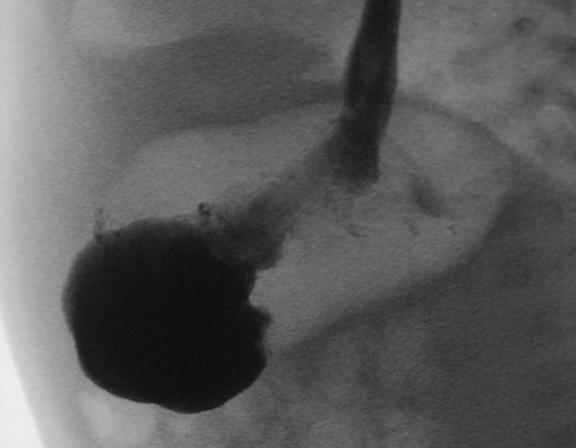 Patient 2: Pylorus Stenosis Radiograph with barium contrast in the stomach Barium is unable to move