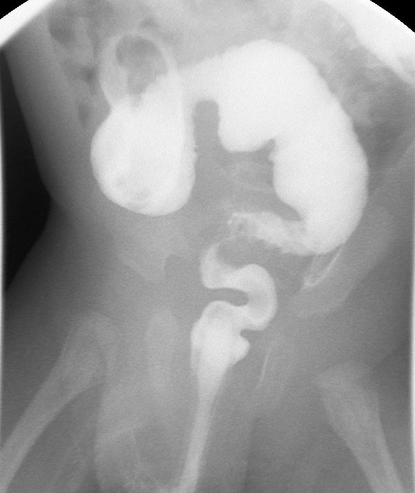 Patient 4: Hirschsprung Disease Supine x-ray with contrast in the large bowel.