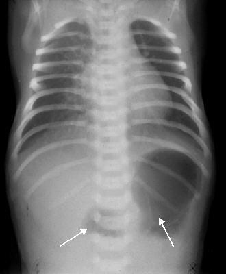 Patient 5: Duodenal Atresia Characteristic double-bubble showing air in the stomach and