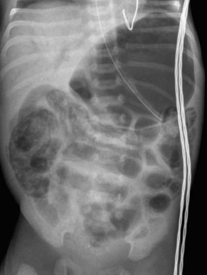 Patient 6: Necrotizing Enterocolitis (NEC) This supine abdominal radiograph shows dilated loops of bowel Pneumatosis coli appears as linear lucencies along the bowel wall