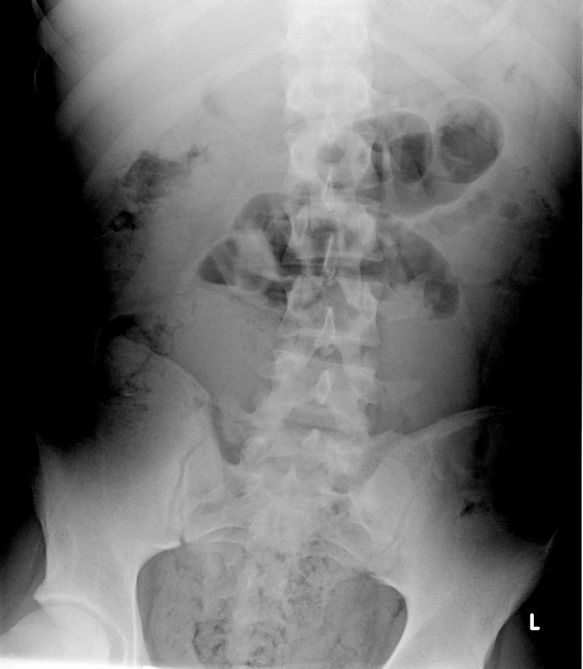 Patient 1: Initial KUB Plain abdominal film shows mildly dilated loops of SB with multiple air fluid levels.