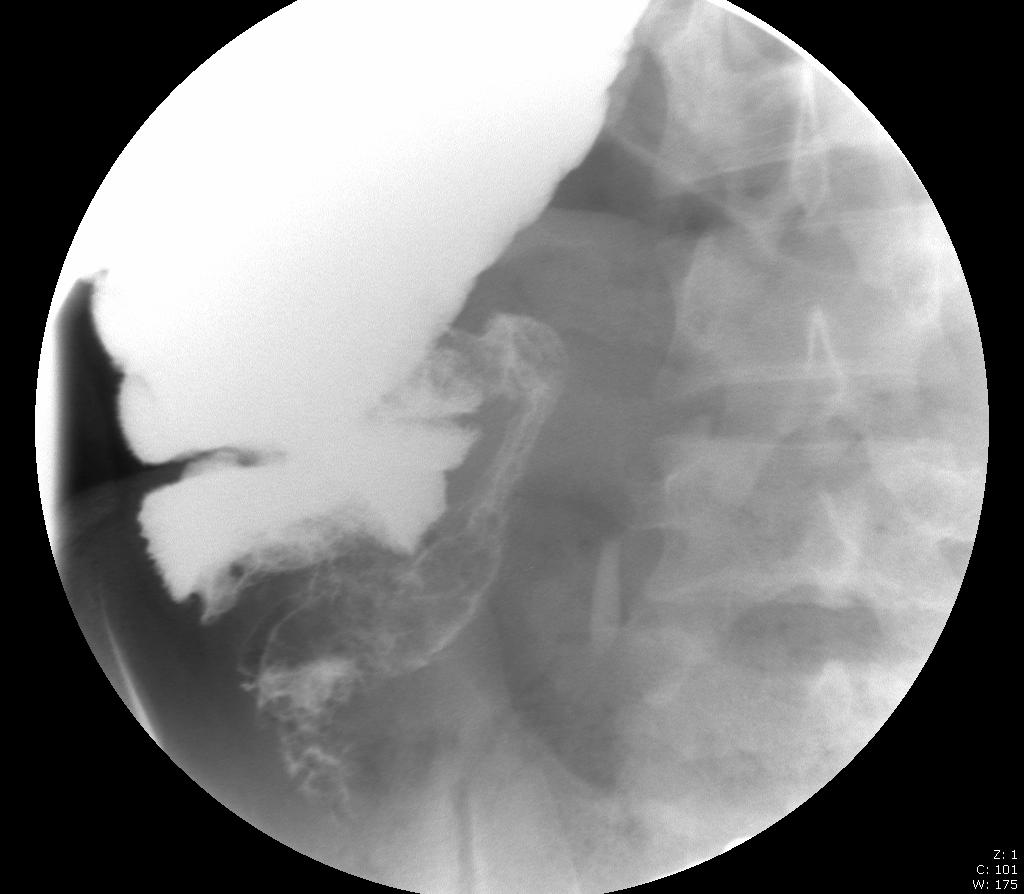 Patient 1: Intussuscpetion on Enemas can be used both to diagnose and treat intussuscption, with successful reduction occurring in 75-90% of cases Here gastrograffin was used to opacify