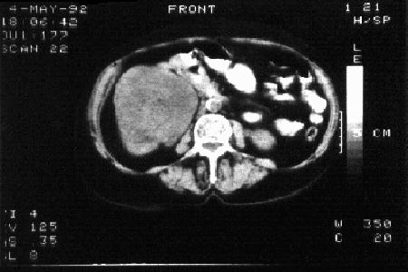FIGURE 1. Case 1. CT Scan. Renal cancer of the right kidney. FIGURE 2. Case 1. Abdominal CT scan of the left adrenal mass.