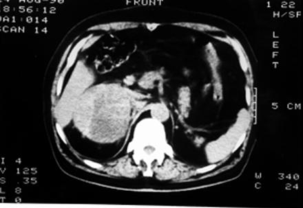 FIGURE 7. Case 2. Abdominal CT scan of the right suprarenal mass. FIGURE 8. Case 2. Selective right renal arteriogram with highly vascular suprarenal mass which displaces kidney interiorly.