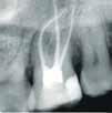 ramifications 3-dimensional obturation Recommended for long, narrow and curved canals Optimal
