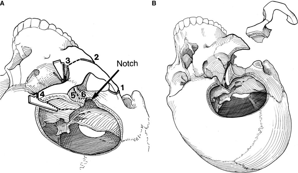 HSU ET AL. FIGURE 1. Illustration of orbitozygomatic osteotomy.