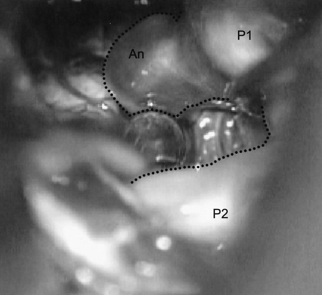microscissors. The posterior communicating artery can be observed piercing this arachnoid membrane, and its course on the far side (projected onto Liliequist s membrane; dotted line) can be observed.