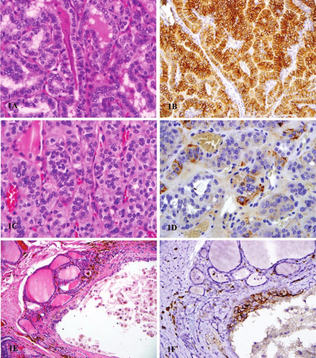 Figure 1. A through F, Trophoblastic cell surface antigen 2 (TROP2) staining pattern in thyroid neoplasm and lesions. A, Papillary thyroid carcinoma (PTC), follicular variant.