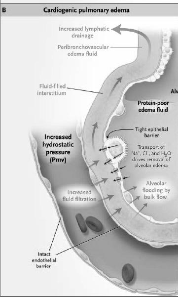 When left atrial pressure increases, hydrostatic pressure increases in the microcirculation and the rate of transvascular