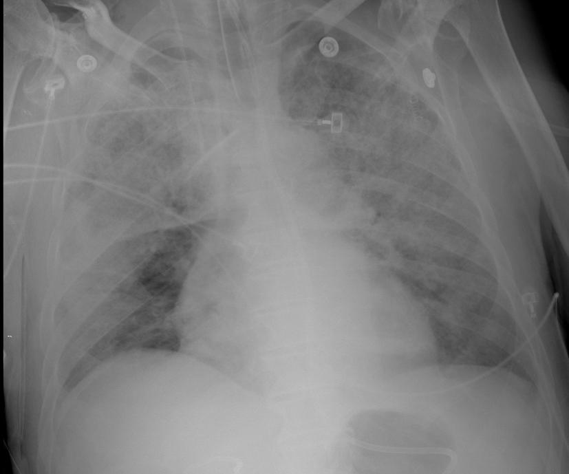 a butterfly pattern around the hila, and pleural
