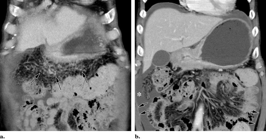 RG f Volume 26 Number 1 Lim et al 153 Figure 14. Peritoneal metastasis from poorly differentiated adenocarcinoma (confirmed at endoscopic biopsy) in a 59-year-old man with stomach cancer.