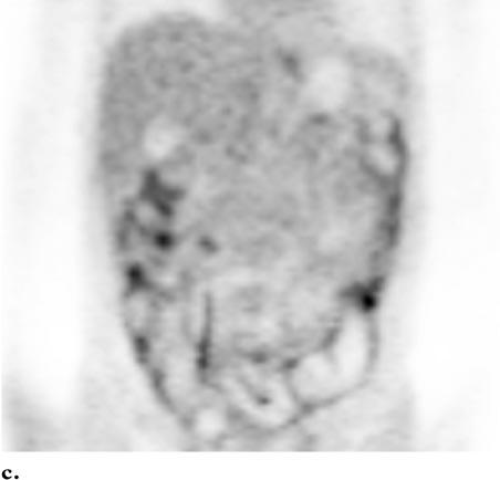 (b) Coronal reformatted CT image demonstrates ascitic fluid (*) and parietal peritoneal thickening (arrows), findings that suggest peritoneal metastasis.