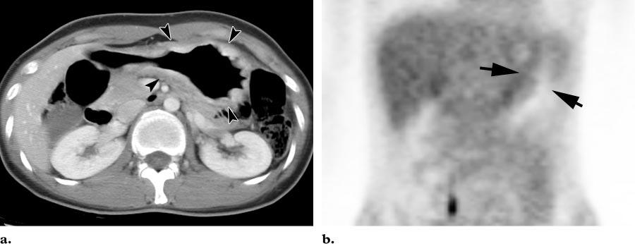 146 January-February 2006 RG f Volume 26 Number 1 Figure 2. Signet ring cell carcinoma without significant FDG uptake in a 30-year-old woman with stomach cancer.