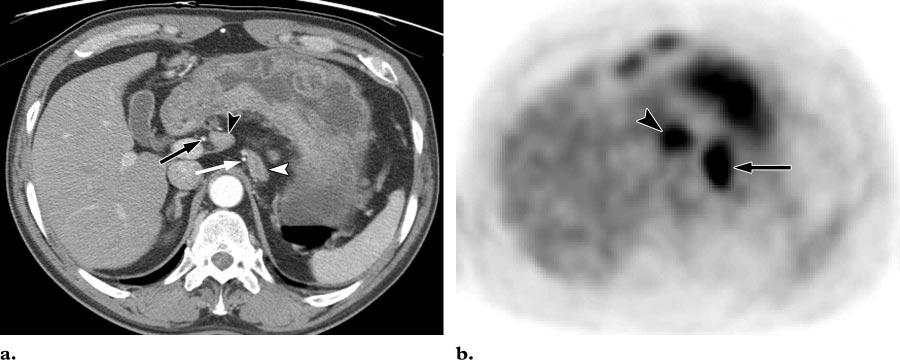 RG f Volume 26 Number 1 Lim et al 147 Figure 4. Station 7 and 8 lymph node metastases in a 63-year-old man with stomach cancer.