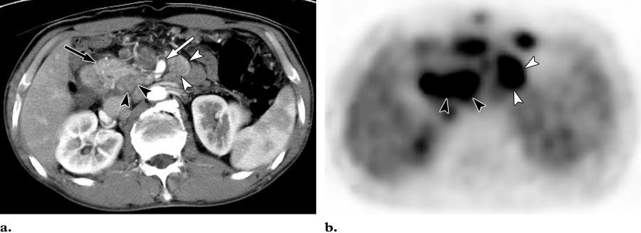 148 January-February 2006 RG f Volume 26 Number 1 Figure 6. Multiple station 13 and 14 lymph node metastases in a 52-year-old man with stomach cancer.