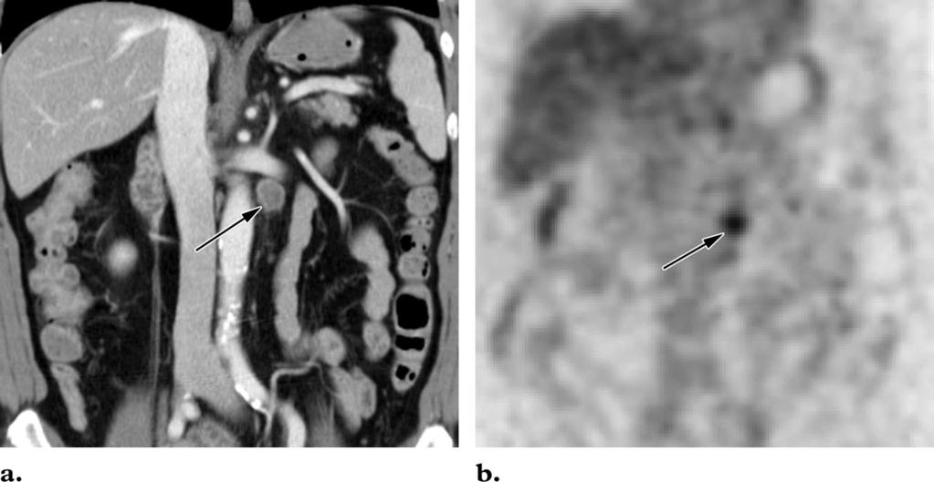 RG f Volume 26 Number 1 Lim et al 149 Figure 7. Station 16 lymph node metastasis in a 55-yearold man with stomach cancer.