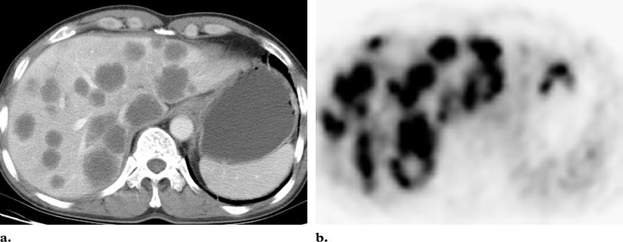 Multiple hepatic metastases in a 58-year-old man with stomach cancer. (a) Portal venous phase CT scan shows multiple metastatic nodules in both hepatic lobes.