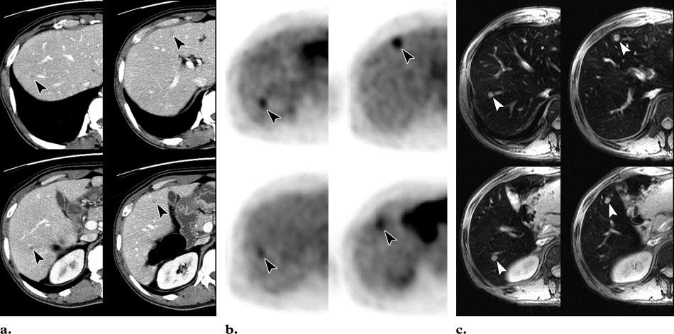150 January-February 2006 RG f Volume 26 Number 1 Figure 9. Small hepatic metastases in a 54-year-old man with stomach cancer.