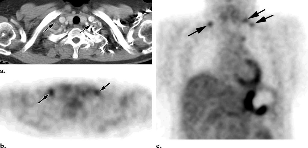 RG f Volume 26 Number 1 Lim et al 151 Figure 11. Supraclavicular lymph node metastasis in a 44-year-old woman with stomach cancer.