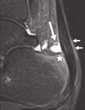 MRI of the Ankle and Hindfoot Fig. 21 Haglund syndrome in 55-year-old man.