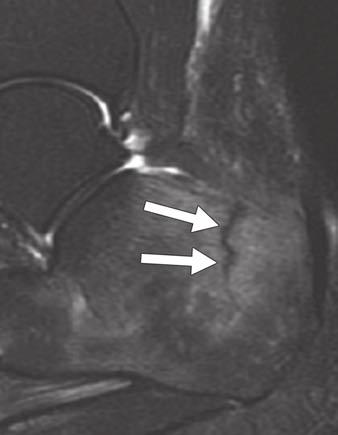 retrocalcaneal bursitis (long arrow) and insertional Achilles tendinosis (short arrows). Fig.