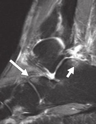 Sagittal STIR image shows that there is abnormal contact between distal fibula and lateral calcaneus and