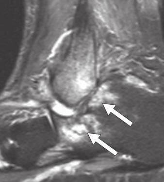 22 Stress fracture of posterosuperior calcaneus in 43-year-old woman.
