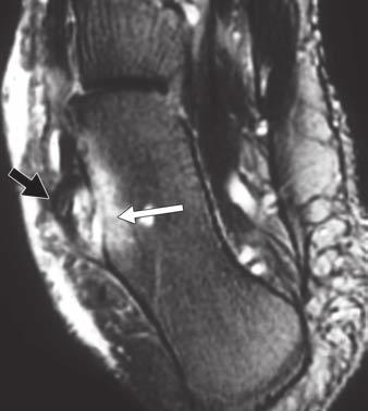 25 Calcaneal vascular grooves (arrow), seen on this sagittal STIR image of 25-year-old woman, at critical