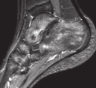 MRI of the Ankle and Hindfoot Fig. 1 High turnover in 12-year-old girl.