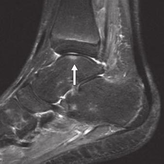 ligament avulsions are seen on coronal fat-suppressed T2-weighted image.