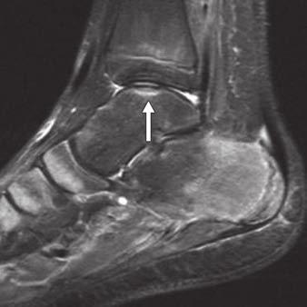 Medial malleolar edema may also reflect deltoid or flexor retinacular avulsions. Fig.