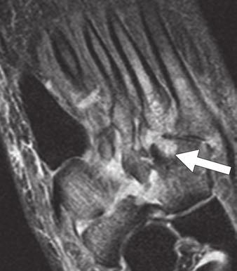Rios et al. Medial and Posteromedial Contusion or fracture Deltoid ligament avulsion Flexor retinacular injury (arrow) PTT dysfunction (white oval) A Fig.