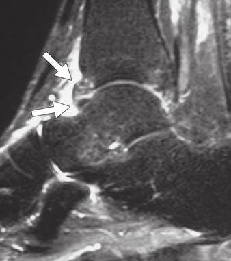 MRI of the Ankle and Hindfoot Fig. 6 Syndesmotic ligament injury in 45-year-old man.