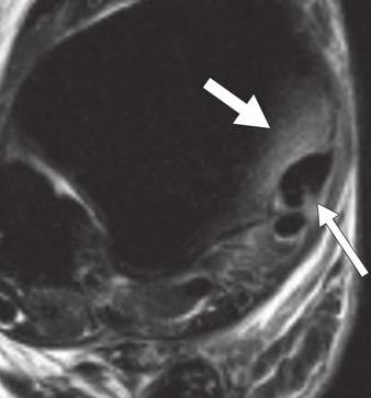 Minimal bone marrow edema, typical of avulsion injury, is noted on axial proton density fatsuppressed image at avulsion site of anteroinferior tibiofibular ligament (long arrow) from tibia.