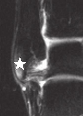 Rios et al. Fig. 11 Calcaneofibular impingement associated with flatfoot in 57-year-old man.
