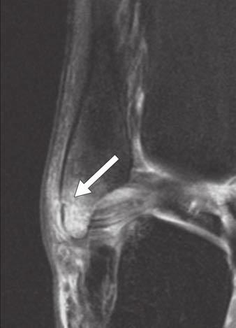 Increased tibiocalcaneal angle (lines) indicates hindfoot valgus. A Fig.
